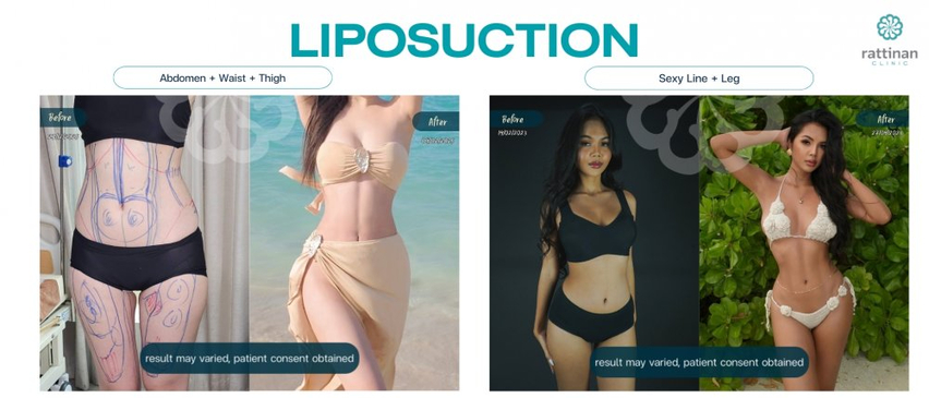 Slider image (4) Calming Confidence in Plastic Surgery at Rattinan Thailand